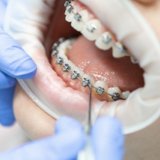 Close up of orthodontist adjusting braces of a patient