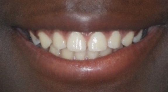 Close up of smile with misaligned teeth