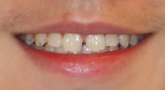 Close up of smile with slightly gapped teeth