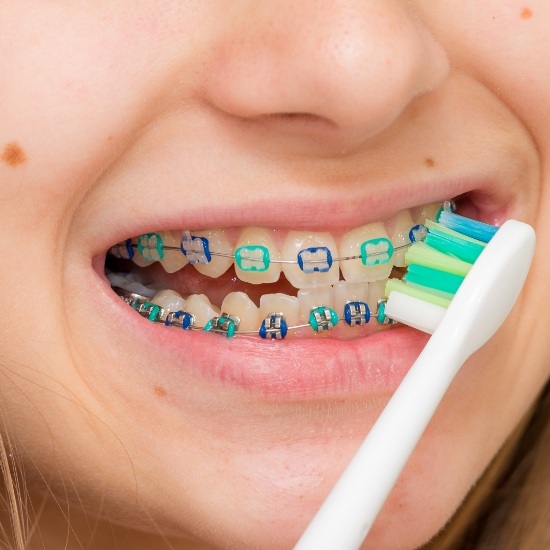 Close up of person with braces brushing their teeth