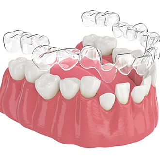 Illustration of clear aligner being placed on misaligned teeth