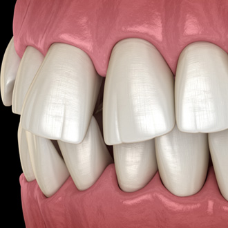 Illustration of gapped teeth