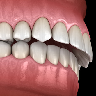 Illustration of an overbite