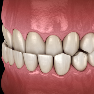 Illustration of an underbite