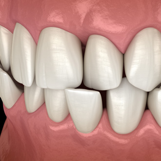 Illustration of a crossbite