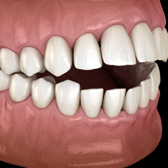 Illustration of an open bite