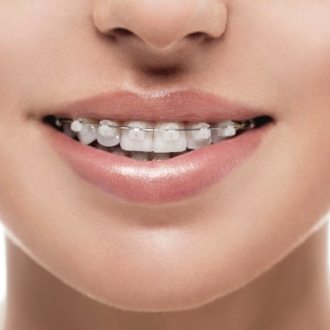 Woman with clear and ceramic braces