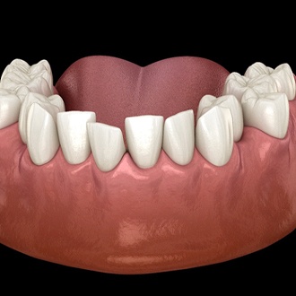 Illustrated row of overcrowded teeth