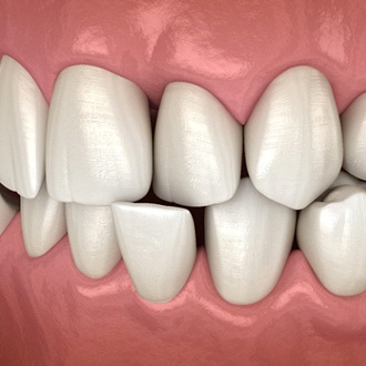 Illustrated mouth with crossbite