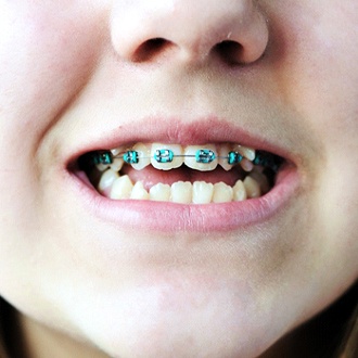 Close up of person with open bite wearing braces on upper teeth