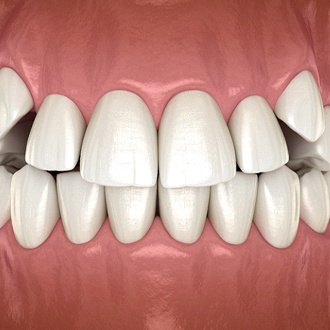 Illustrated mouth with impacted canine teeth